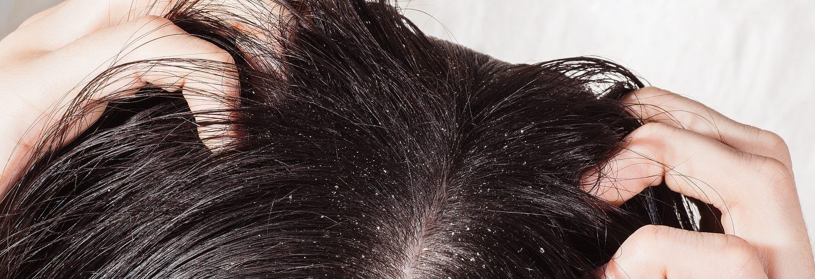Зуд головы и выпадение волос причины. Аллергия на коже головы в волосах.